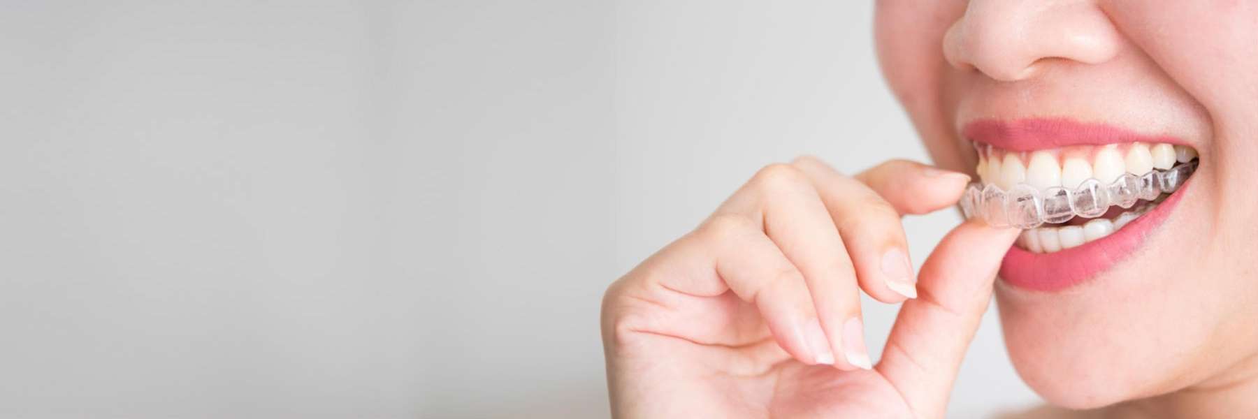 SureSmile® Clear Aligners | Dentist