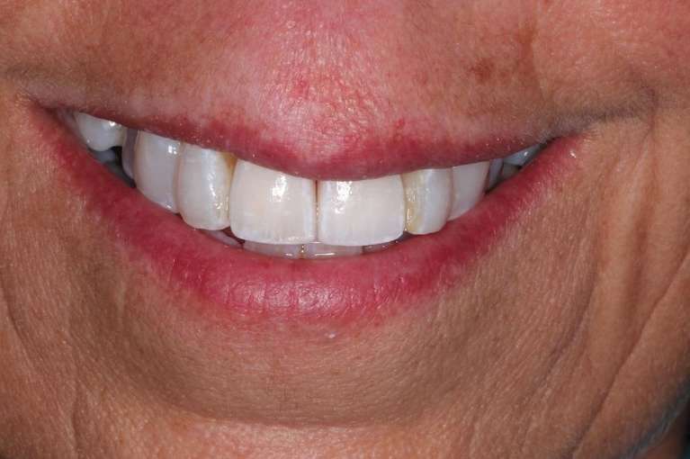 Anterior-Crowns-After-Image