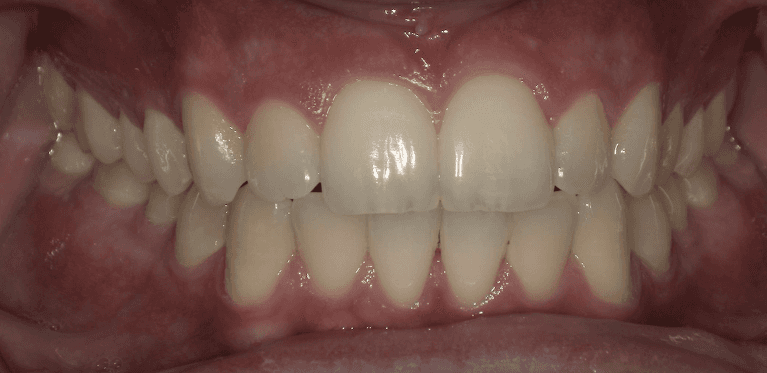 Clear-Aligners-After-Image