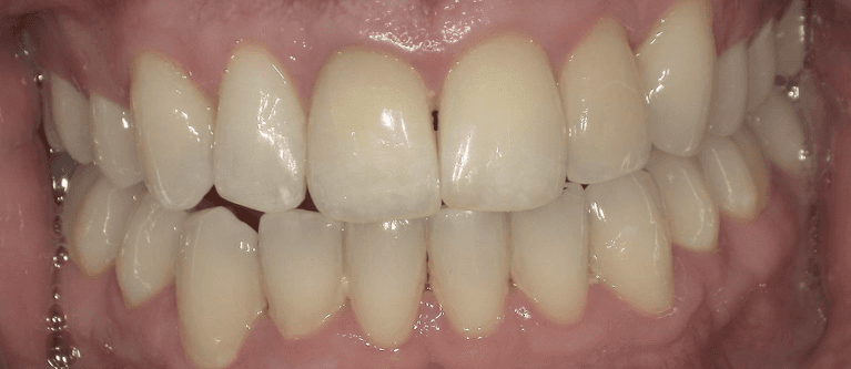 In-House-Whitening-After-Image