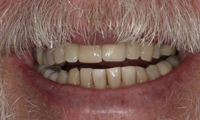 After treatment - Tooth Replacement 