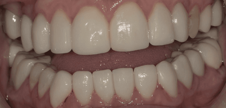 Anterior-Crowns-After-Image