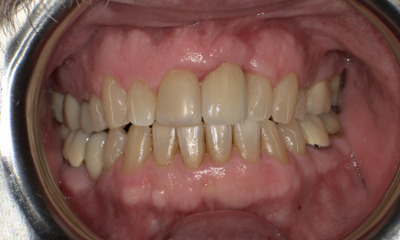 After treatment - Tooth Replacement 