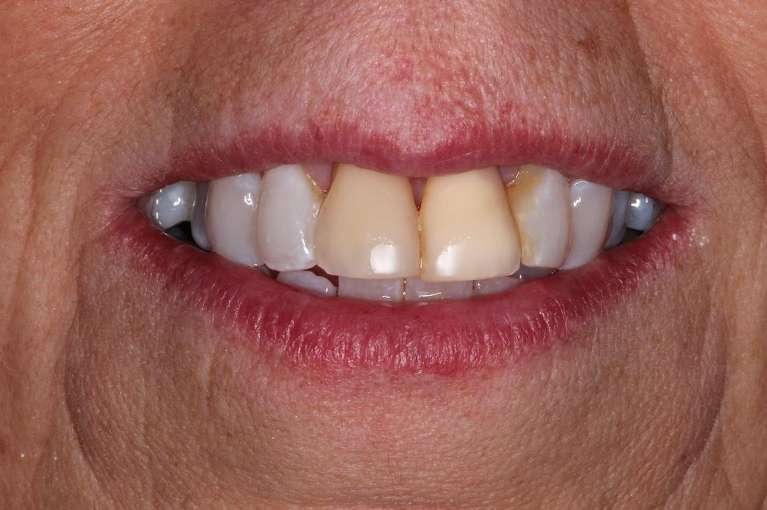 Anterior-Crowns-Before-Image
