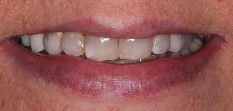 Anterior-Crowns-Before-Image