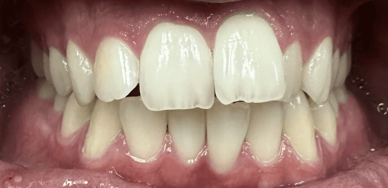 Clear-Aligners-Before-Image