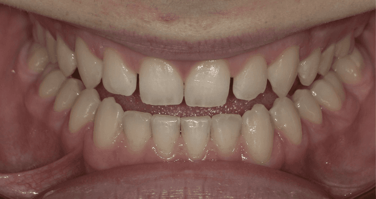 Bonding-Before-Image