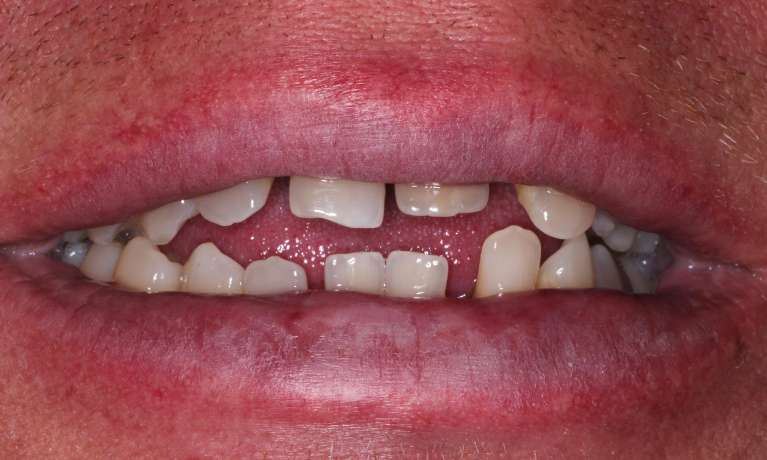 Implant-and-Bridge-Before-Image