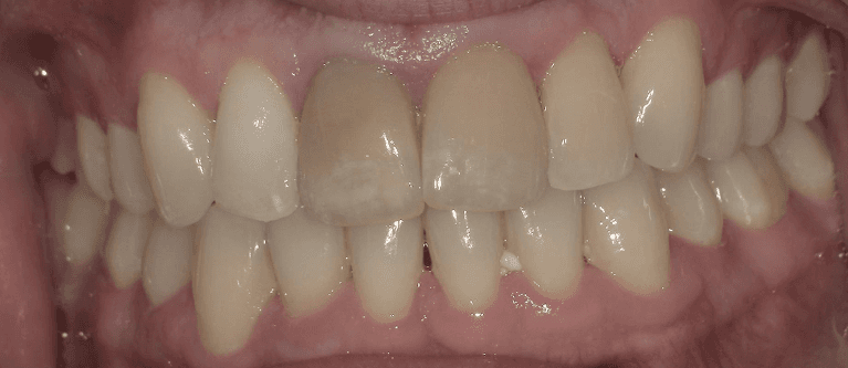 In-House-Whitening-Before-Image
