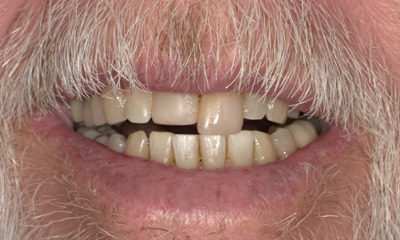 Before treatment - Tooth Replacement 