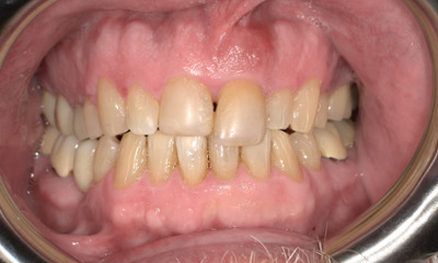 Before treatment - Tooth Replacement 